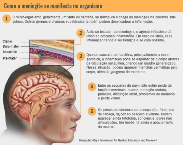meningite-info-cerebro-20111209-original