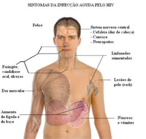 hiv-sintomas